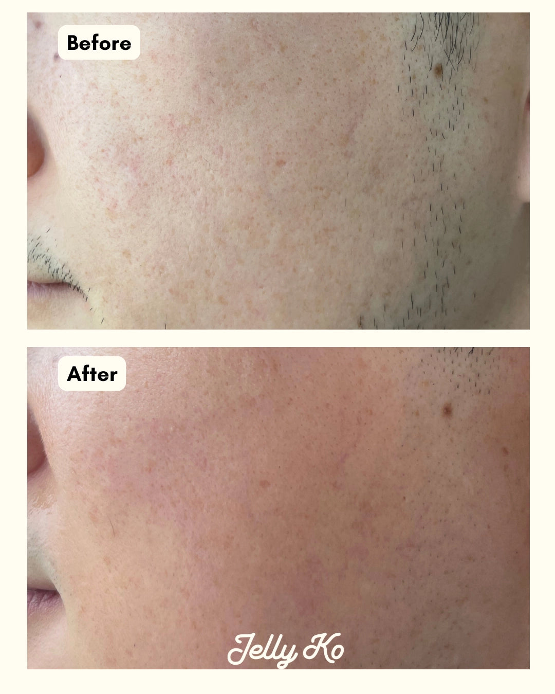 Jelly Ko Toner Before and After