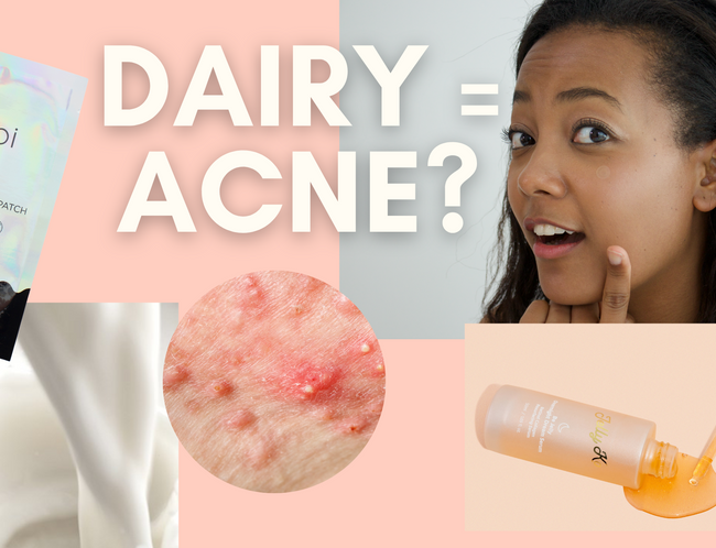 Does Dairy Cause Acne?