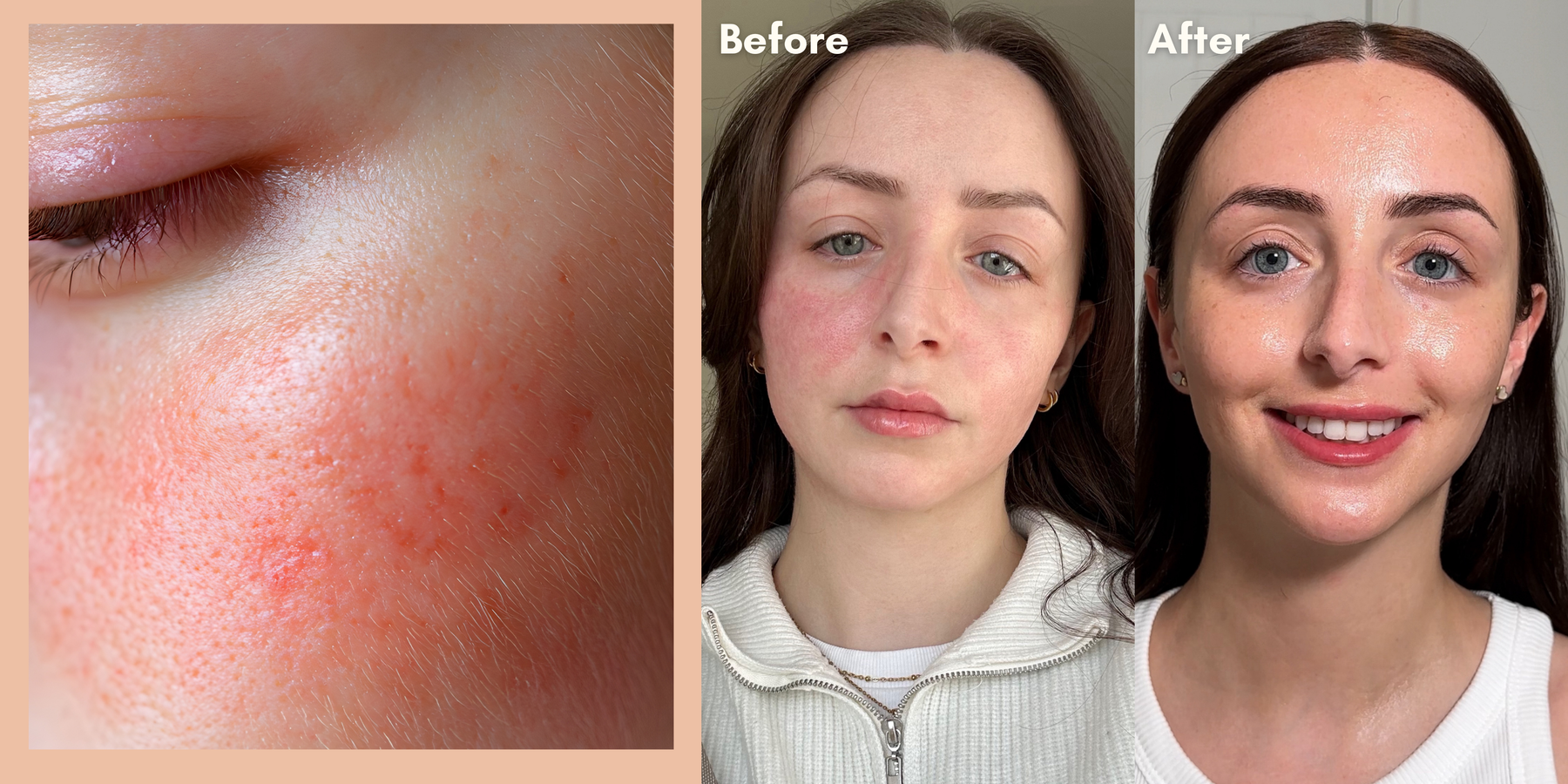 Korean Beauty For Rosacea STYLE STORY