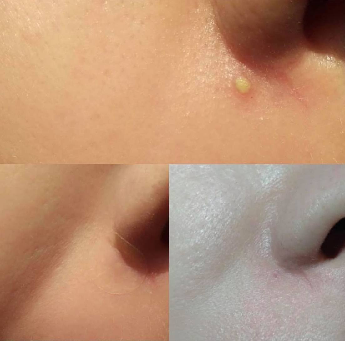 Subi Perfect Pimple Patch